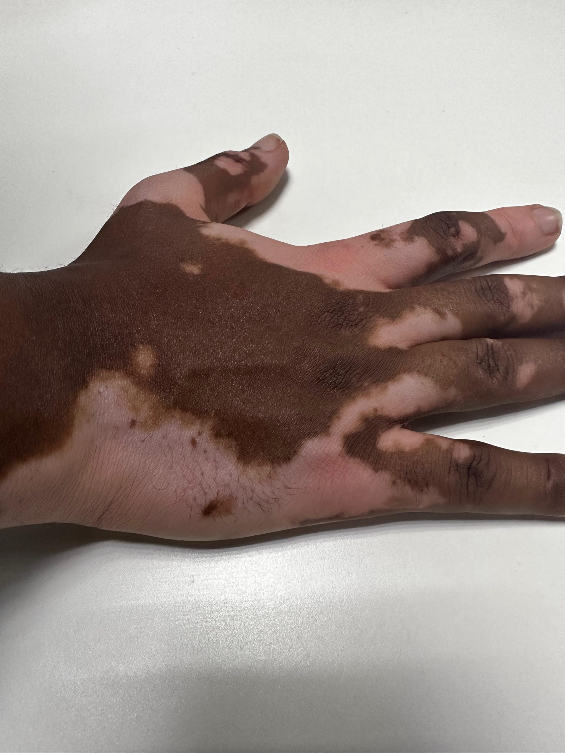 vitiligo management