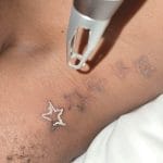 tatoo removal
