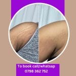 stretchmarks removal