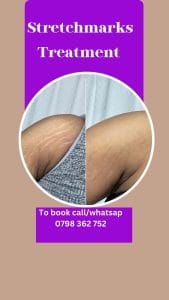 stretchmarks removal