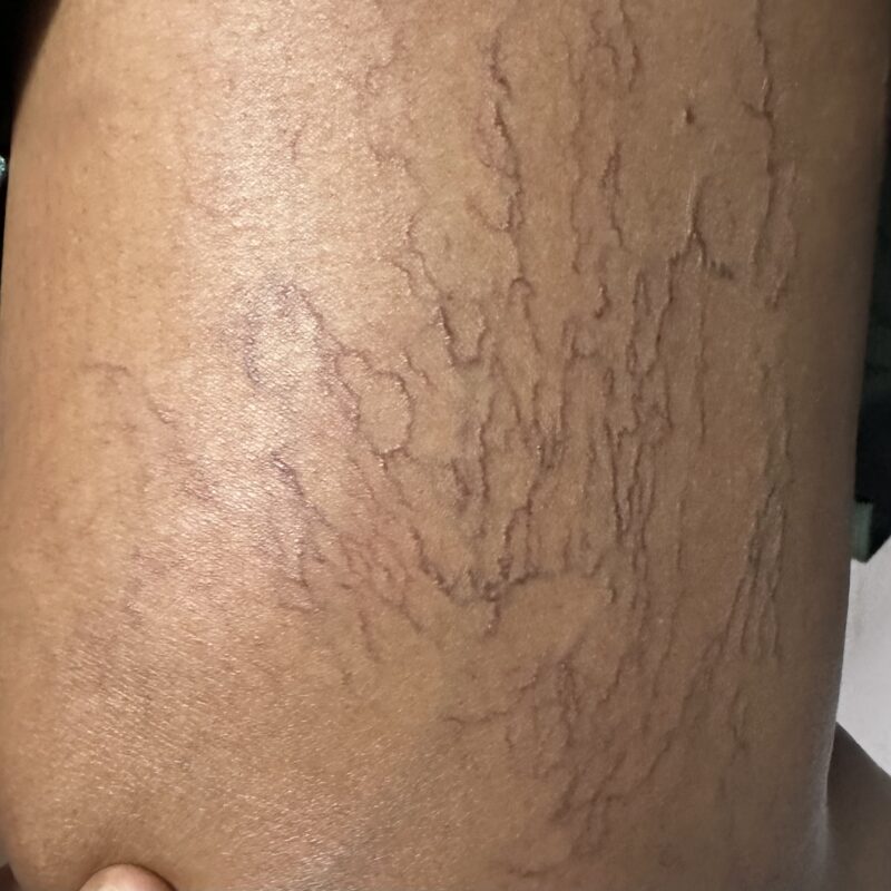Varicose veins removal