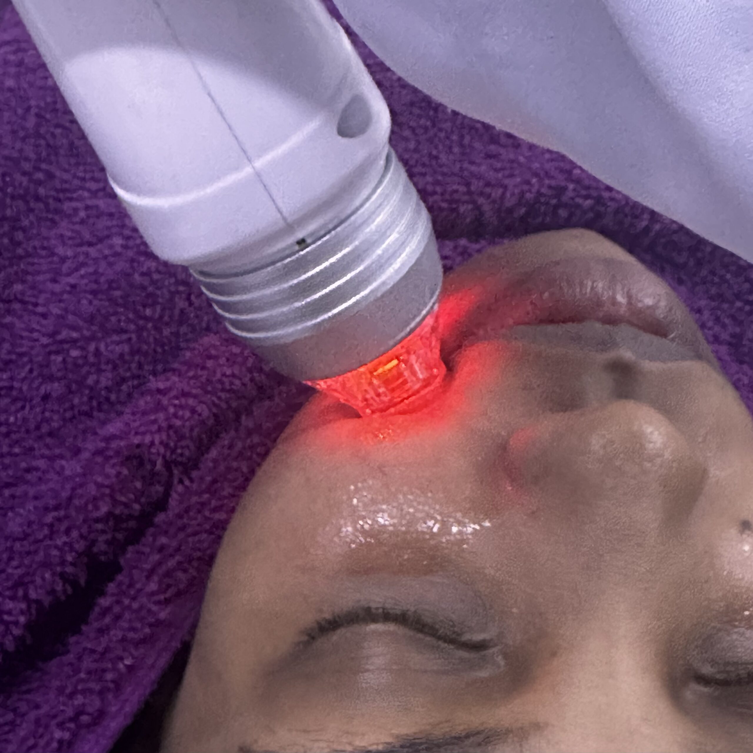 Radio Frequency Microneedling