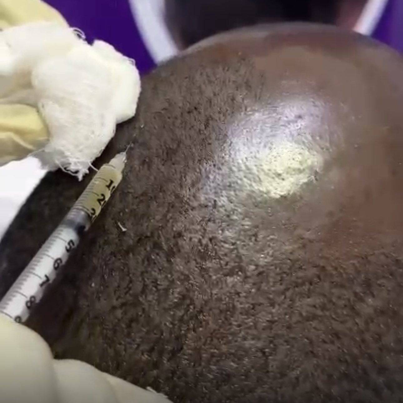 Alopecia treatment using PRP