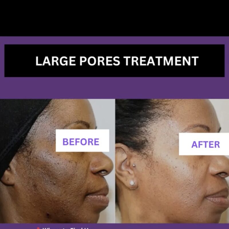 enlarged pores treatment