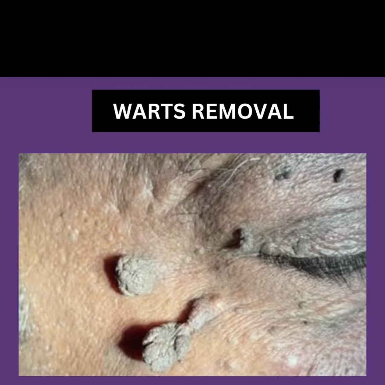 Warts/mole removal