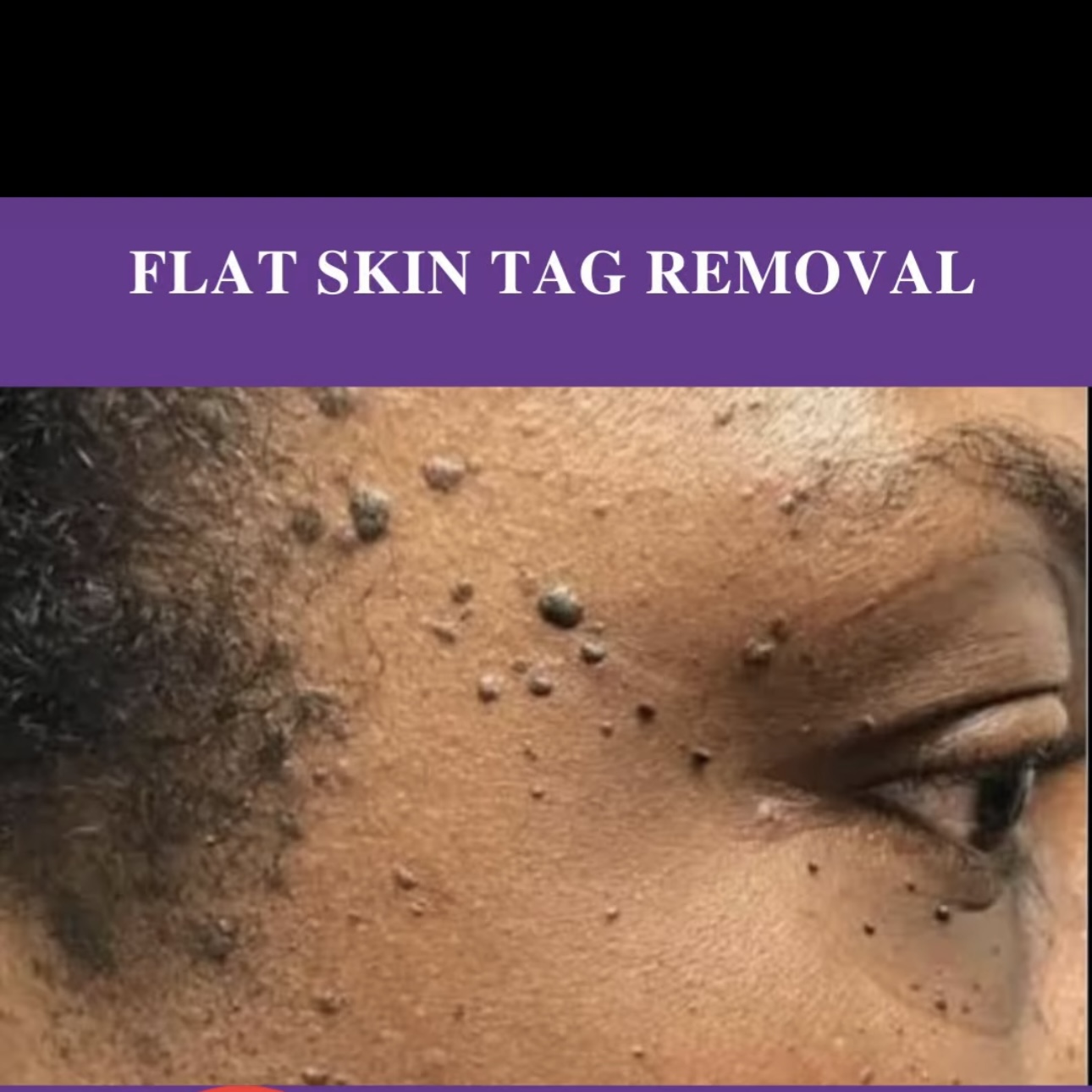 skin tags