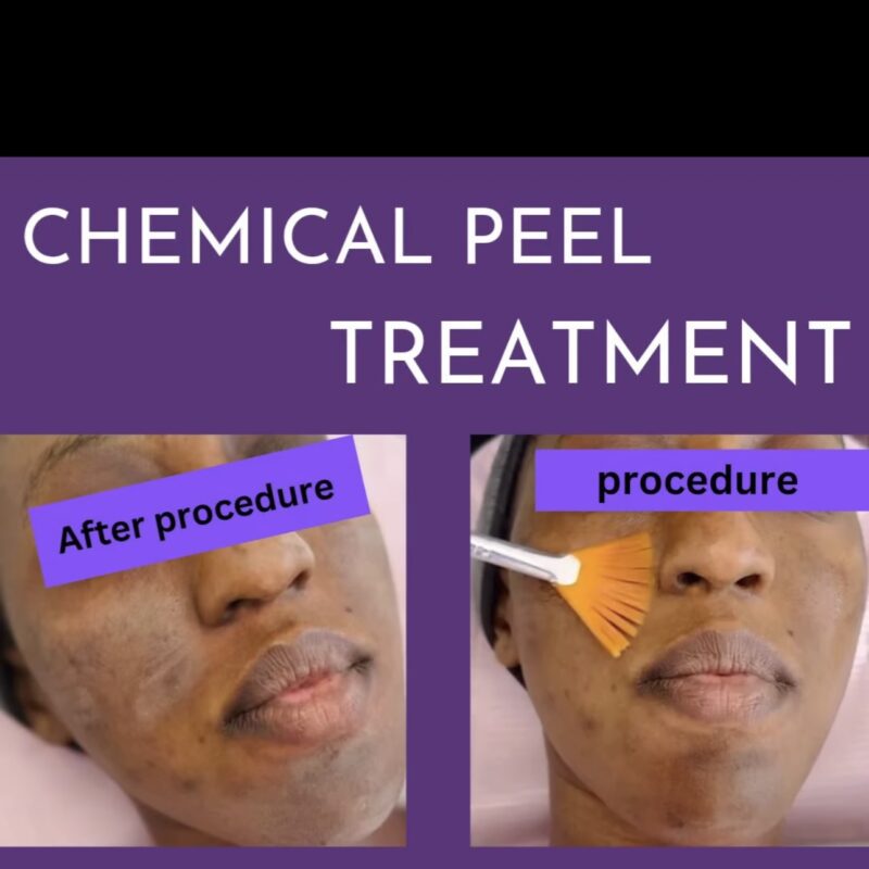 Chemical Peel Treatment