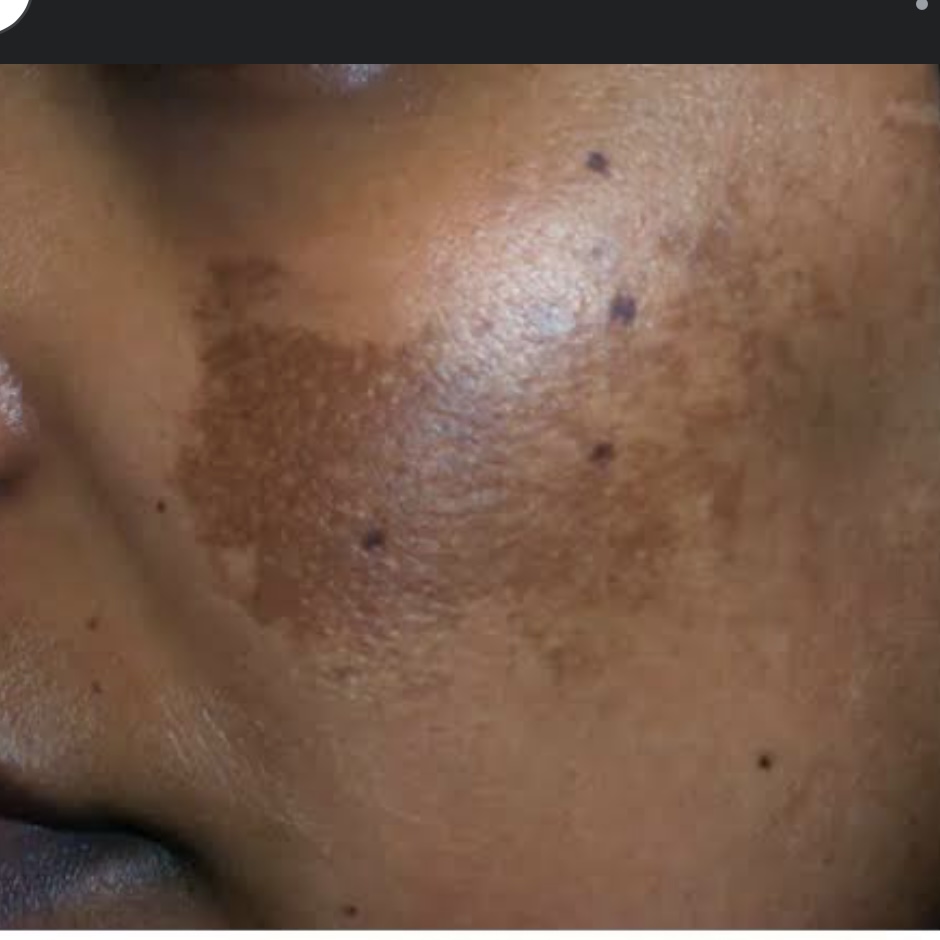 melasma treatment
