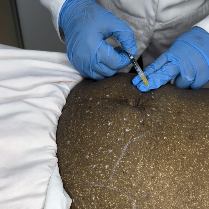 Fat dissolving injections