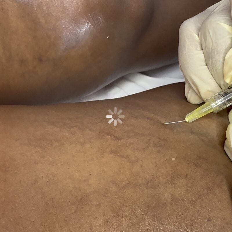 varicose veins removal