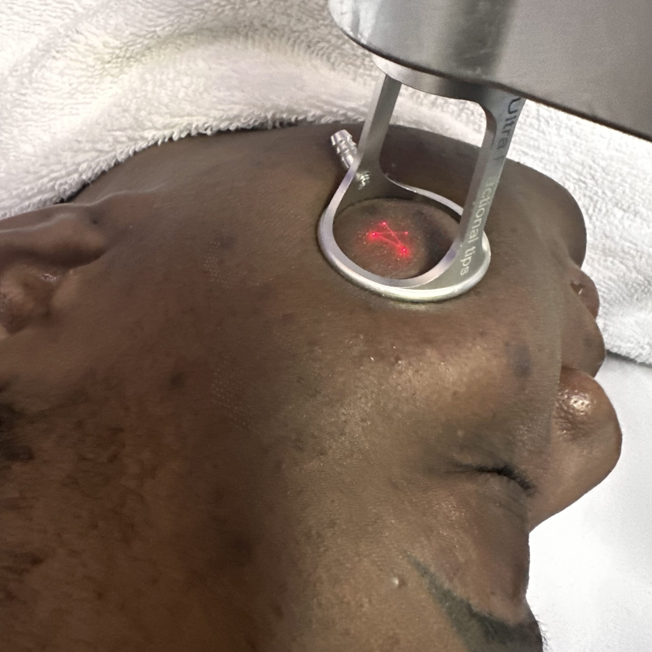 facelift procedures Fractional laser