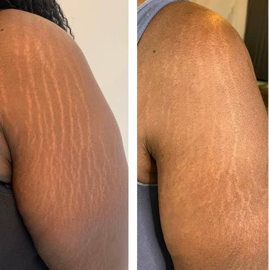 Stretch Marks Removal