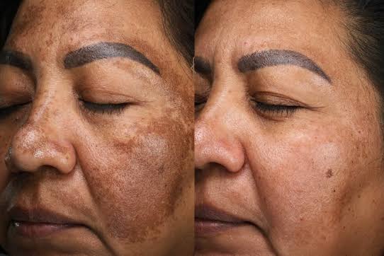 Melasma Treatment