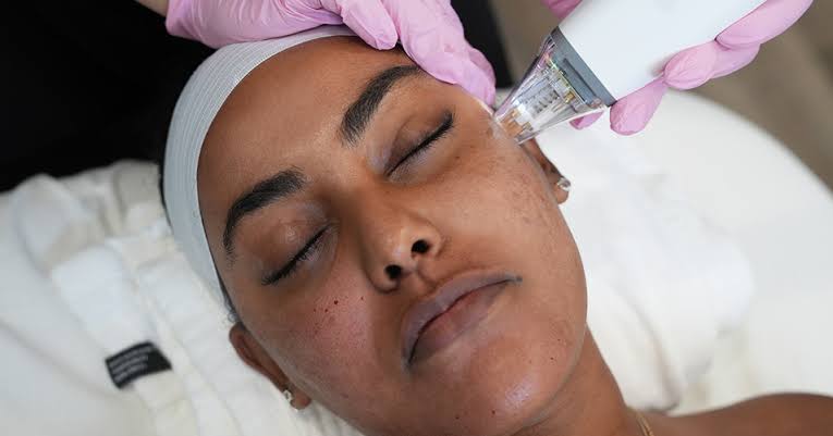 Radio frequency microneedling