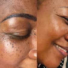 Skin Tag Removal