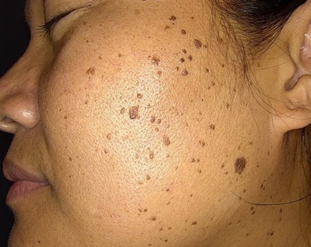 Warts and Moles Removal