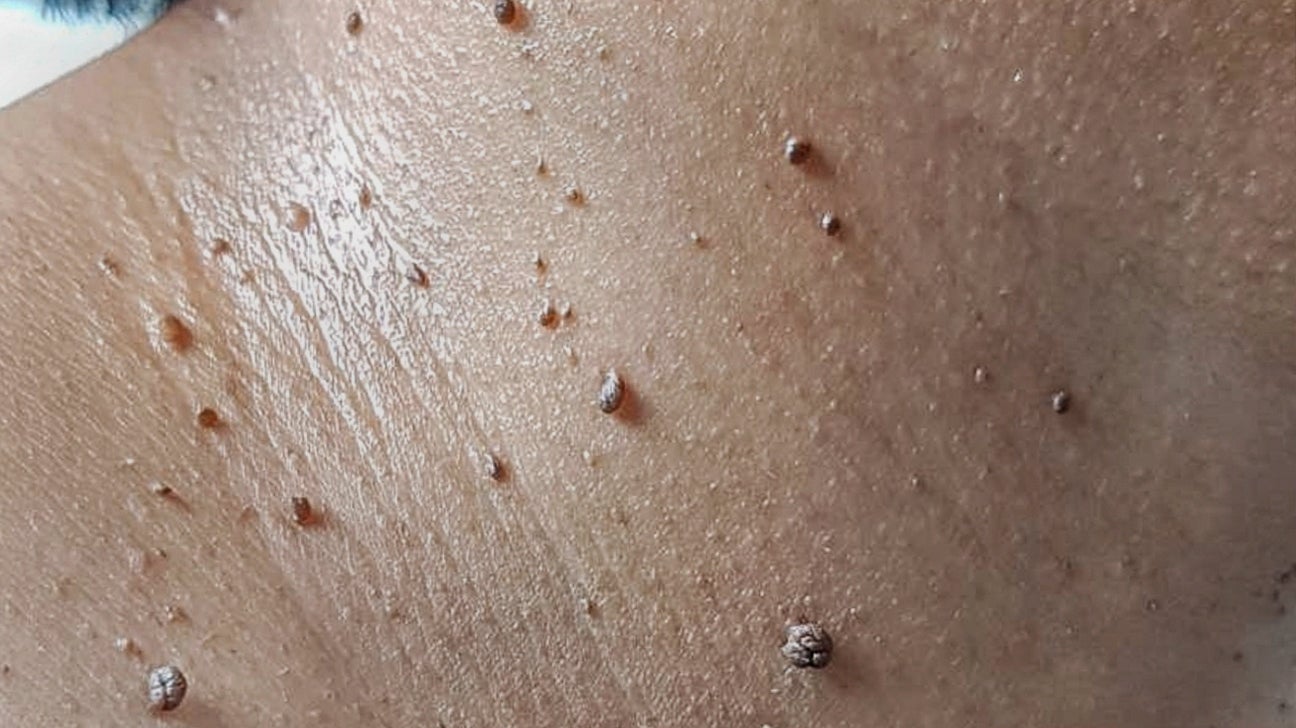 Warts and Moles Removal