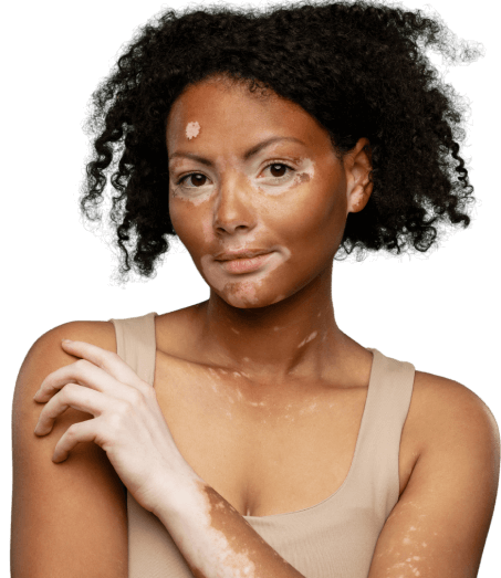 Vitiligo Management