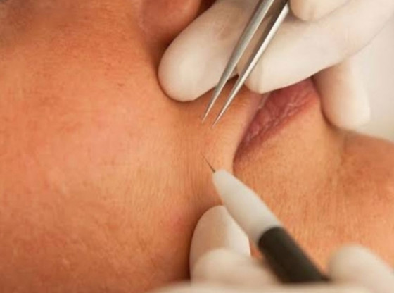 Electrolysis Hair Removal