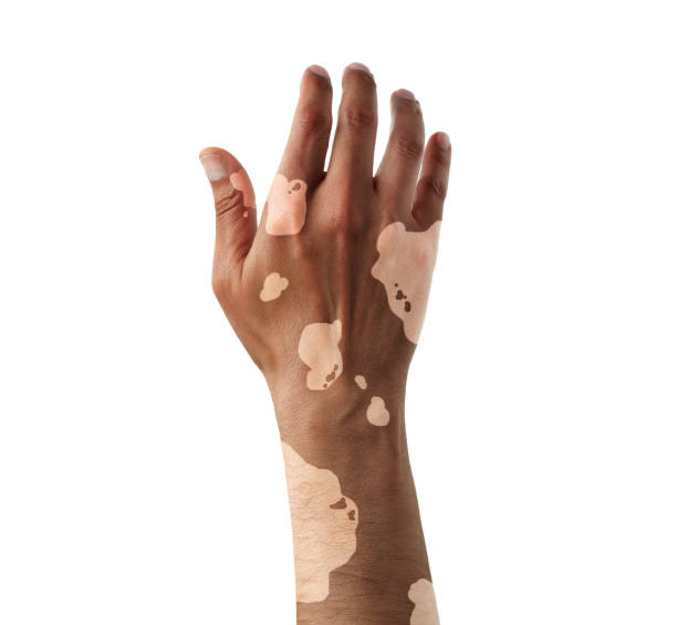 Vitiligo Management