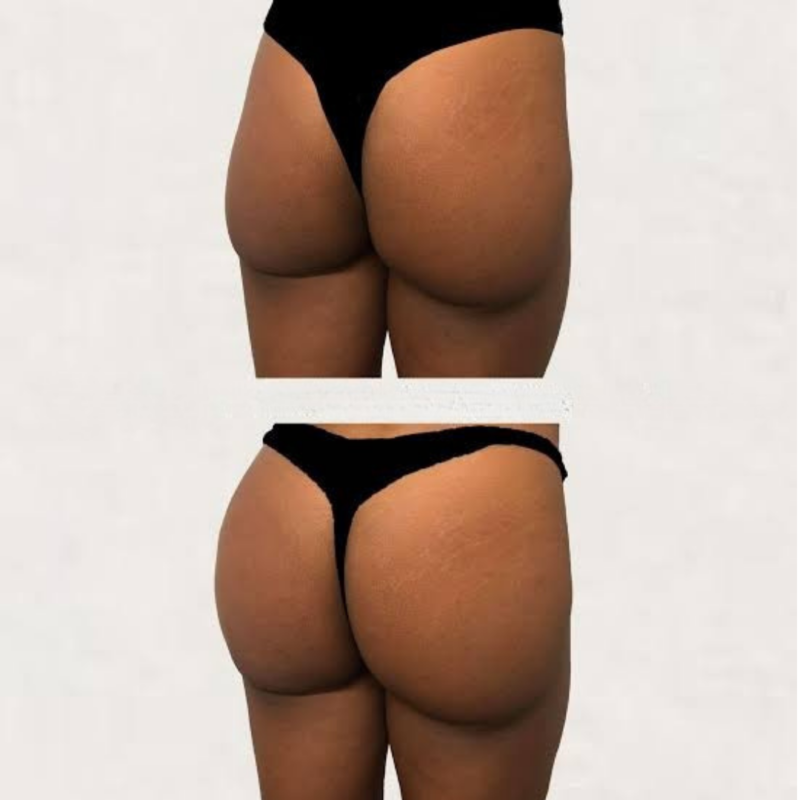 Butt Fillers in Nairobi before and after
